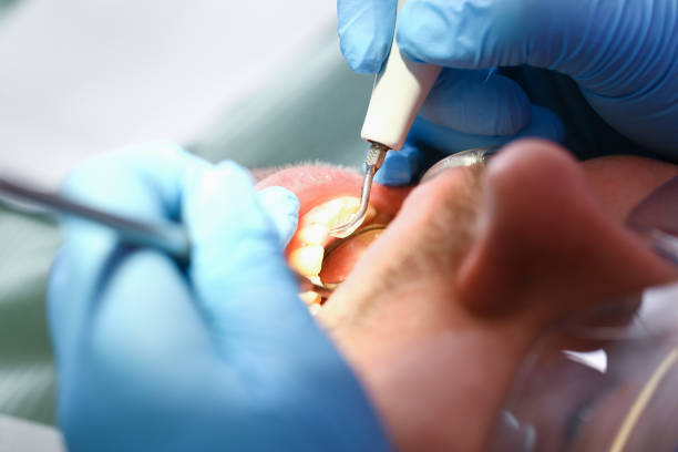 Best Emergency Tooth Extraction in South Fulton, TN